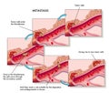 Metastasis