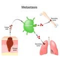 Metastasis. cancer invasion. malignant tumor