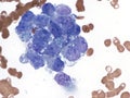 Breast cancer. Bone marrow metastases. Cytology. Royalty Free Stock Photo