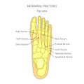 Metatarsal fractures Royalty Free Stock Photo