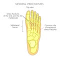 Metatarsal Stress fractures Royalty Free Stock Photo