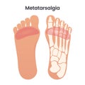 Metatarsalgia Pain in the Ball of the Foot medical educational vector illustration graphic Royalty Free Stock Photo