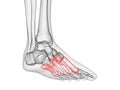 The metatarsals bone