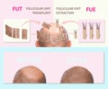 Methods of hair transplantation fut vs fue with infographic elements of illustration. Royalty Free Stock Photo