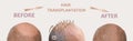 Methods of hair transplantation fut vs fue with infographic elements of illustration. Royalty Free Stock Photo