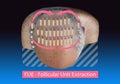 Methods of hair transplantation fut vs fue with infographic elements of illustration. Royalty Free Stock Photo