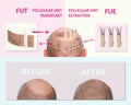 Methods of hair transplantation fut vs fue with infographic elements of illustration. Royalty Free Stock Photo