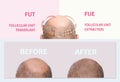 Methods of hair transplantation fut vs fue with infographic elements of illustration. Royalty Free Stock Photo