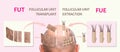 Methods of hair transplantation fut vs fue with infographic elements of illustration. Royalty Free Stock Photo