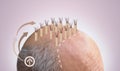 Methods of hair transplantation fut vs fue with infographic elements of illustration. Royalty Free Stock Photo