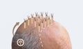 Methods of hair transplantation fut vs fue with infographic elements of illustration. Royalty Free Stock Photo