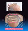 Methods of hair transplantation fut vs fue with infographic elements of illustration. Royalty Free Stock Photo