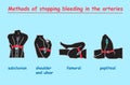 Methods of stopping bleeding in the arteries black body. info graphic