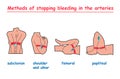 Methods of stopping bleeding in the arteries. info graphic