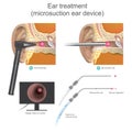 The Micro suction ear device it is vacuum working system.Doctor