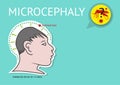 Microcephaly or abnormal smallness of the head linked to Zika Fever Virus