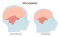 Microcephaly. Birth defect caused by Zika virus, medical condition