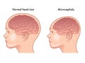 Microcephaly