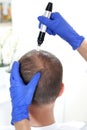 Microneedle mesotherapy of the scalp.