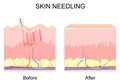 Microneedling. skin needling