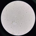 Microorganism and white blood cell in urine