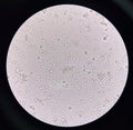 Microorganism and white blood cell in urine