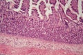 Microscope photo of a large intestine section with inflammation Colitis