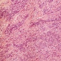 Microscope picture of benign nerve tumour