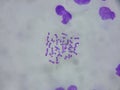 Human chromosomes under the microscope Royalty Free Stock Photo