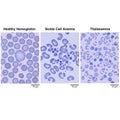 Microscopic blood smear images display three different conditions Royalty Free Stock Photo