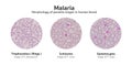 Microscopic examination of blood films from malaria infected pat