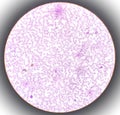 Microscopic finding, Neutrophilic leukocytosis with thrombocytosis.