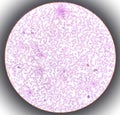 Microscopic finding, Neutrophilic leukocytosis with thrombocytosis.