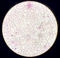 Microscopic finding, Neutrophilic leukocytosis with thrombocytosis.