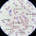 Microscopic image of blood cells highlighting various abnormalities Royalty Free Stock Photo