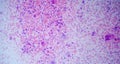 Microscopic image of a cytology of a non-small cell lung tumor. Medical themes