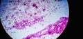 Microscopic image of a cytology of a non-small cell lung tumor. Medical themes Royalty Free Stock Photo