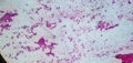 Microscopic image of a cytology of a non-small cell lung tumor. Medical themes