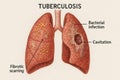 Microscopic Lung Tissue Showing Tuberculosis Infection Medical Pathology Royalty Free Stock Photo