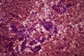 Microscopic image of pancreatic cancer. Royalty Free Stock Photo