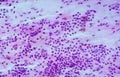 Microscopic analysis of Paps smear showing HPV related changes. Cervical cancer. SCC