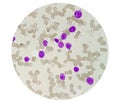 Microscopic image showing Chronic myeloid leukaemia (CML) is a type of cancer.