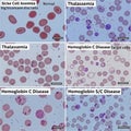 From the normal round shape. Thalassemia displays varied cell Royalty Free Stock Photo