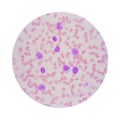 Microscopic view of a blood smear from leukemia patient showing