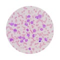 Microscopic view of a blood smear from leukemia patient showing Royalty Free Stock Photo