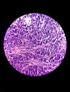 Microscopic view of stained slide of Histology. A Slide of malignancy. Biopsy. Cancer.