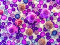 Microscopic Visualization of Myelodysplastic Syndrome MDS in Bone Marrow Biopsy A Detailed Cellular Analysis for Royalty Free Stock Photo