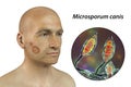 Microsporum canis fungal infection, 3D illustration