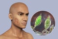 Microsporum canis fungal infection, 3D illustration