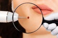 Microsurgery. Removal of birthmark from client`s chin with laser device. Doctor`s hand holding a magnifier glass for zoom. Close